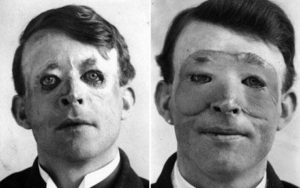 Don’t Look at these Photos At Night, Trust Us! | Originol
Walter Yeo Skin Graft